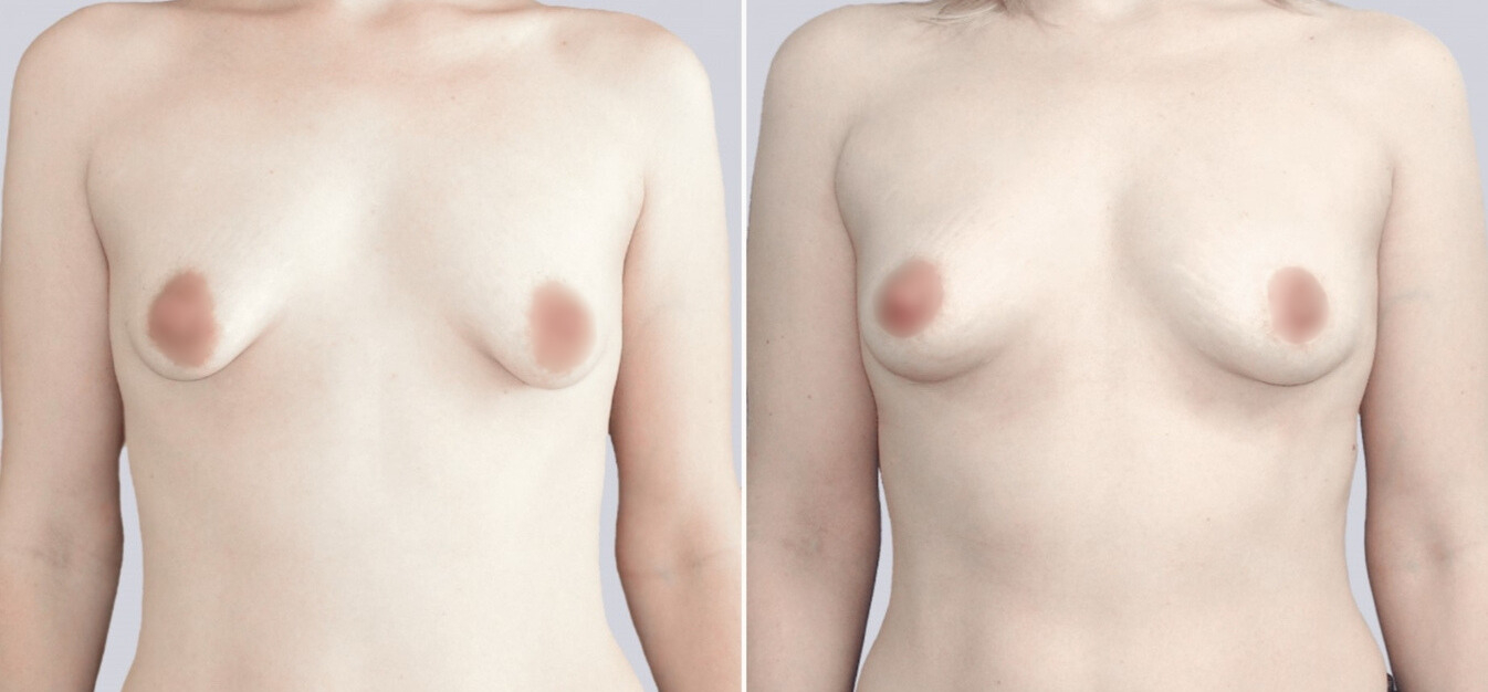 Липофилинг груди до и после изображение 2