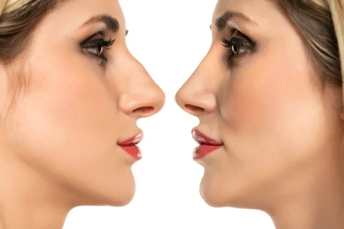 Пластическая операция носа: какого эффекта можно ожидать?