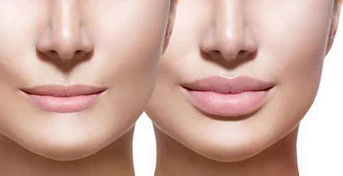 Увеличение губ: пластическая операция или другие методы?